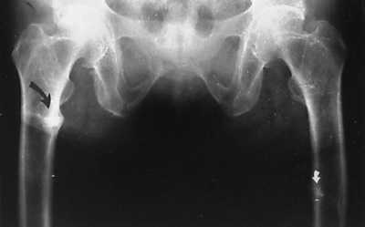 Osteomalacia X Ray